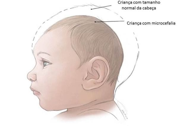 bebe-com-microcefalia-640-427