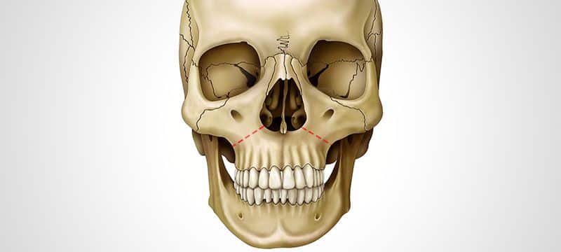 Osso maxilar – Wikipédia, a enciclopédia livre